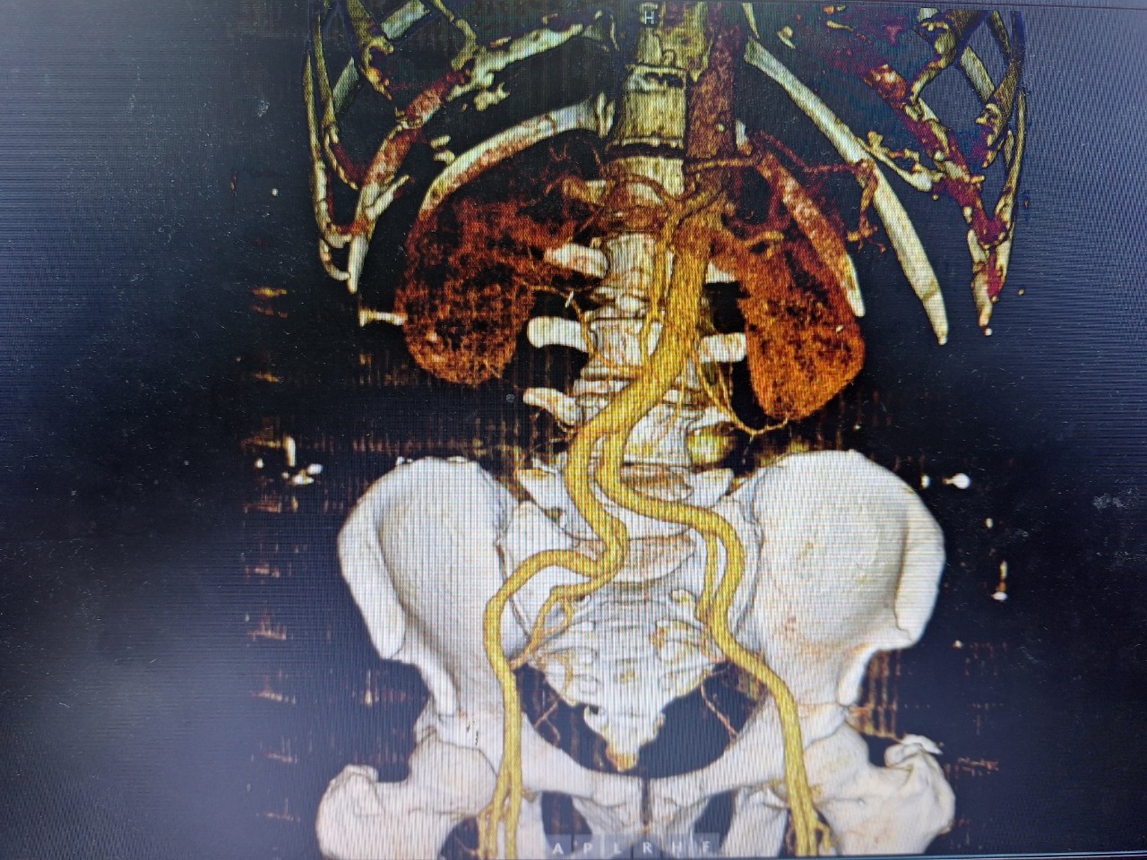 (ĐCSVN) - ThS.Bs Nguyễn Thế Dũng – Khoa Nội tiêu hóa cho biết, các nghiên cứu cho thấy can thiệp qua động mạch quay có ưu điểm so với động mạch đùi gồm: hồi phục nhanh, ít biến chứng xuất huyết nặng, ít biến chứng mạch máu, ít biến cố tim mạch và tử vong, bệnh nhân thoải mái hơn sau thủ thuật do không cần nằm bất động tại giường. 