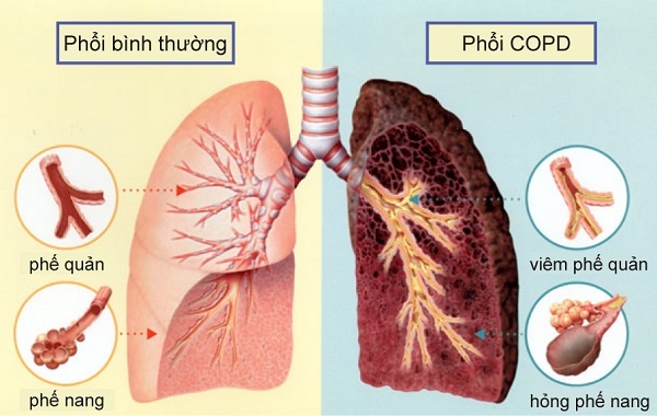 (ĐCSVN)- Theo số liệu Điều tra Quốc gia về tỷ lệ mắc bệnh phổi tắc nghẽn mạn tính (COPD) ở Việt Nam có đến 4,2% dân số mắc COPD. Tỉ lệ này ngày càng gia tăng do nhiều yếu tố nguy cơ như tiếp xúc với các yếu tố độc hại mà đứng đầu là hút thuốc lá, kế đến là ô nhiễm môi trường.